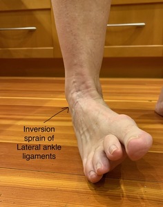 Inversion sprain ankle injuring lateral ankle ligaments